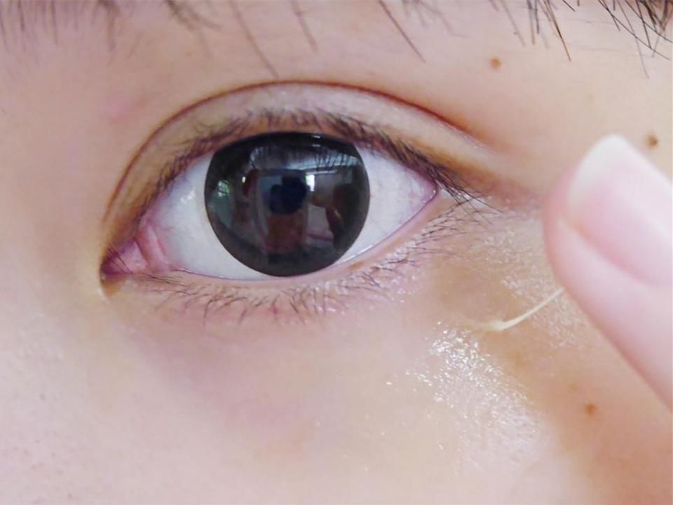 皮肤科教授透露:睡前抹点药店“白菜价乳膏，脂肪粒、眼袋去无影