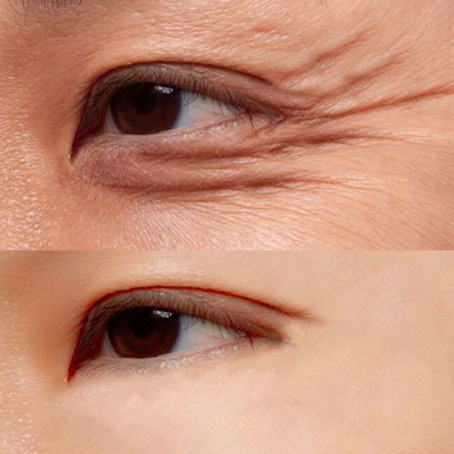 肺腑之言:女人眼袋、眼纹无需打玻尿酸，教你一绝招，纹听话走了