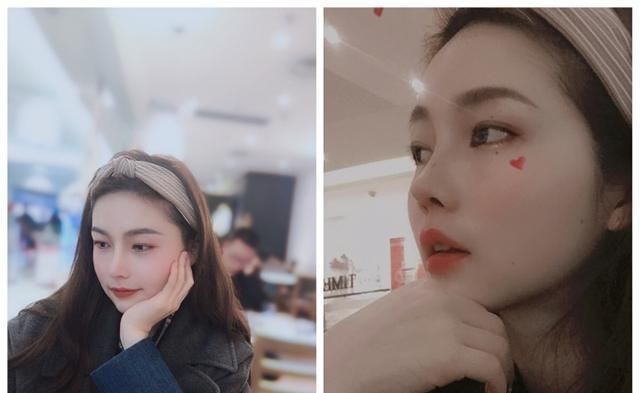  #术后#隆鼻真的有用吗？鼻综合术后六个月记录，这完全不是一个人！