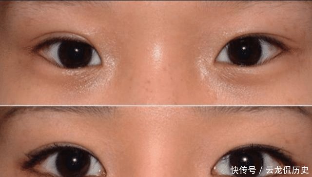 「答案」割了“双眼皮”的人, 等老了之后会变成什么样 答案你可能想不到