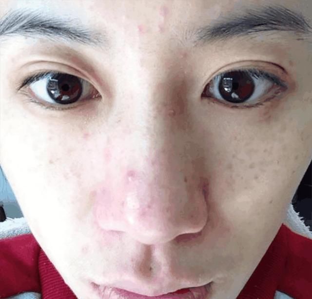 皮肤变成螨虫窝竟浑然不知,3方法教你自检,十试九中2招根除