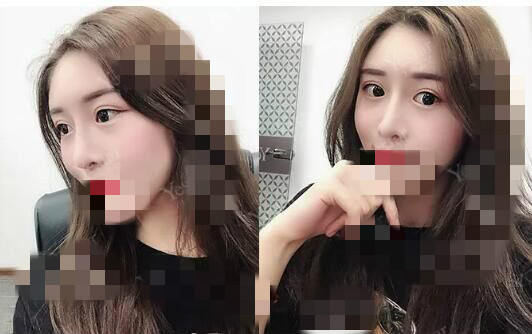 北京艺星割双眼皮确实是对的选择，气质好了