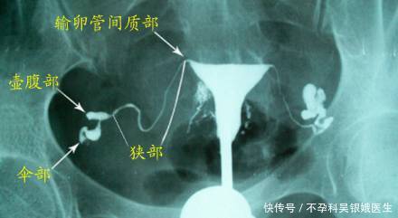 输卵管通液术后当月可以怀孕吗?