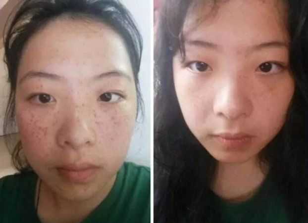 65岁老医生意外透漏:药店常见“液体”加家中常用乳液淡斑快无踪