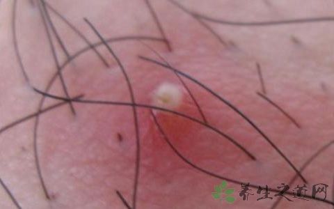 什么叫毛囊清洁 t01b4c402ee29f5af0b.jpg