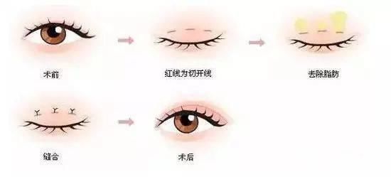  『竟然』什么？你做的双眼皮竟然消失了