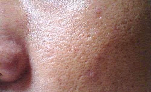 脸上长期有4表现，对不起，螨虫在你毛孔中做窝，交配繁殖下一代