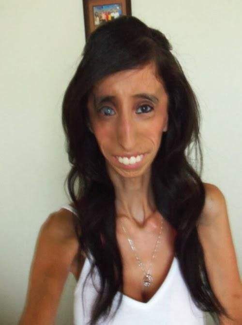 “零脂肪”的患病女孩，身高1米57，体重27公斤