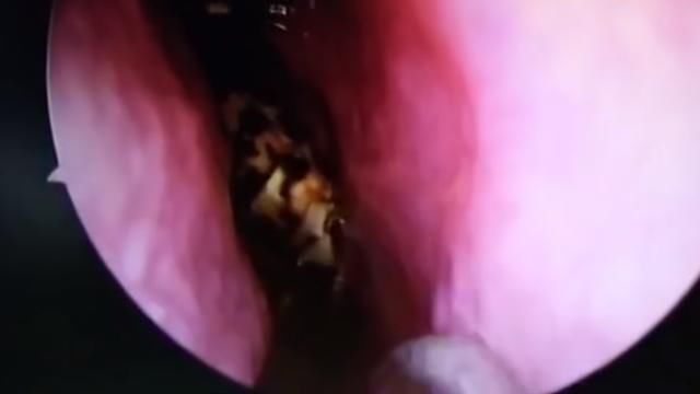 妇女直喊头疼前去检查,发现是脑袋内进了一只