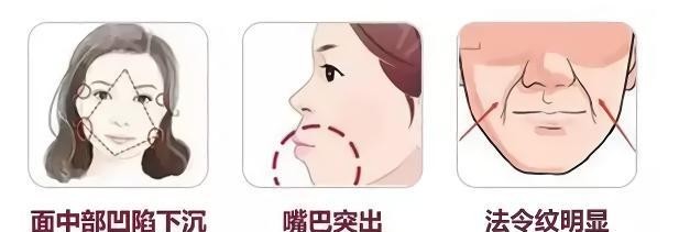  填充：侧面不够立体，可能是鼻基底的问题
