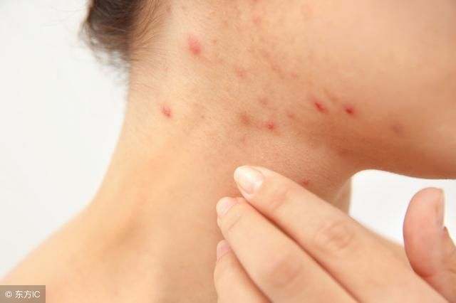 脸上出现4情况,定是螨虫过亿,教你3招逼退螨虫!