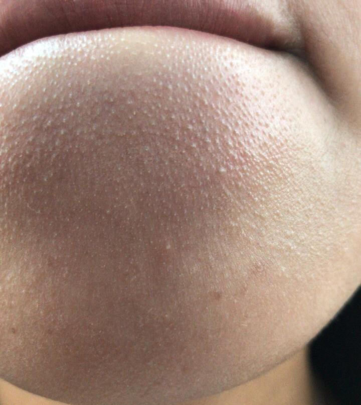 究竟■下巴上冒出白色颗粒,感觉像发脓,究竟是什么东西?怎么消下去?