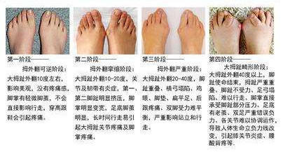 那些长期穿高跟鞋的,脚都变成什么样了?