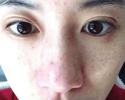  【皮肤上】女性脸上斑点增多，多半因为3个问题引起，3个办法可缓解