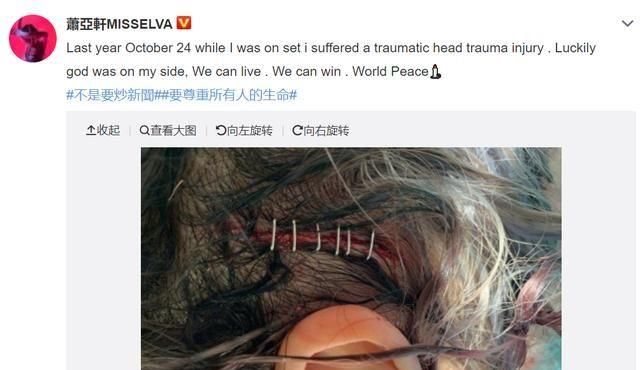  【敬业】40岁萧亚轩豹纹吊带配湿发超性感！恋爱女王头部受伤缝6针超敬业