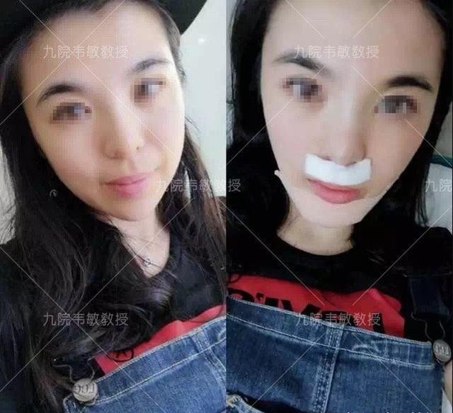 『手术』鼻综合究竟是什么样的手术?进来了解一下吧