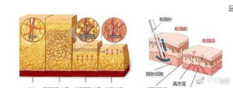  『脂肪细胞』吸脂之前为什么要打肿胀液？吸出来的脂肪是什么样子？