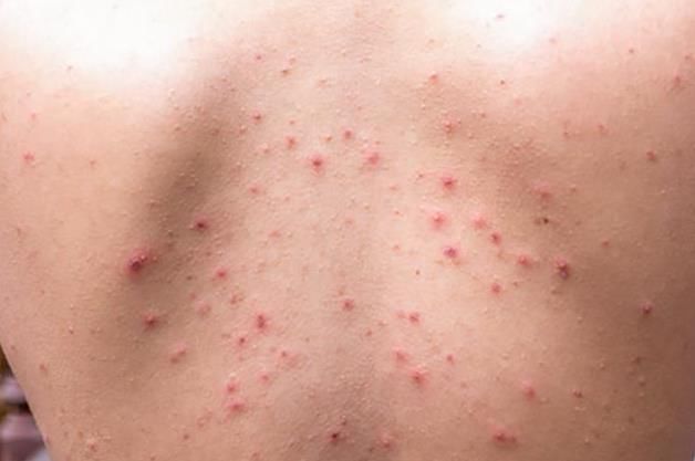 螨虫在后背疯狂爆发会有4迹象，坚持用3招一脚“踹飞”螨虫