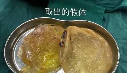  [王川颖告诉记者]没想到！触目惊心！女子30年前隆胸，如今取出这两坨东西.......