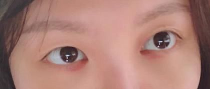 了去■割眼袋多久恢复自然呢?我亲身经历了去眼袋手术恢复的点点滴滴