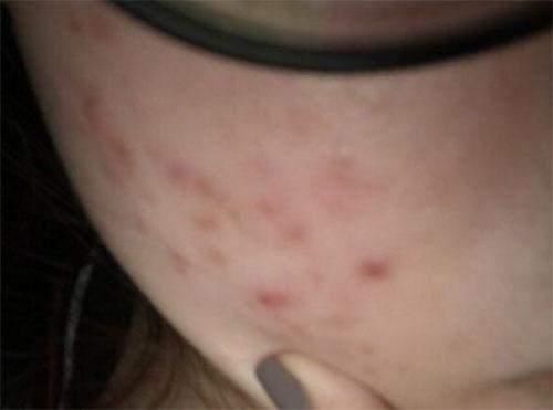 脸上长期有4表现，对不起，螨虫在你毛孔中做窝，交配繁殖下一代