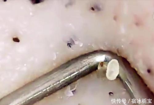  【没错】想要告别丑陋的黑头，皮肤科医生教你4个步骤，照着做准没错