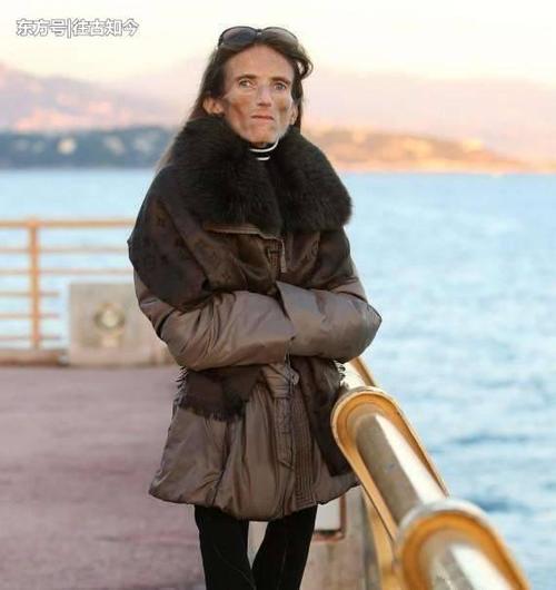 女子身高1.73米, 体重只有50斤, 廋成了一具“干尸”