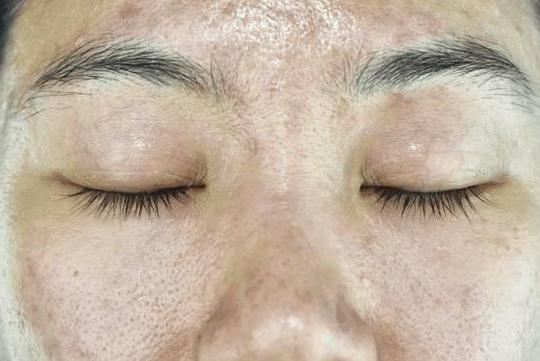 三伏天痘痘频发, 出现3个症状要警惕了, 毛孔可能被螨虫堵住了