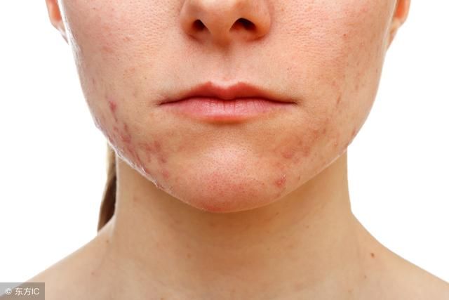 螨虫是皮肤“噩梦”，许多人不知道螨虫怕什么，3招直捣螨虫窝