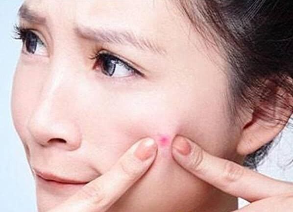 螨虫”肆虐让人顶着满脸痘痘怎么办？学会这些方法就能除螨祛痘！