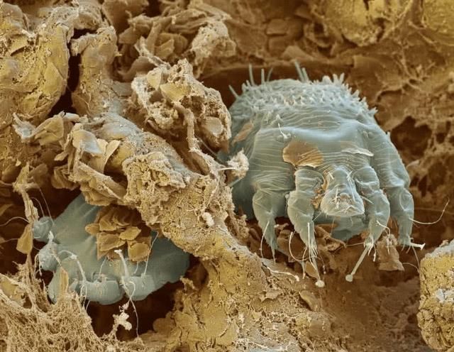 后背常有这3个表现，只要把堵毛囊的9层螨虫排出来，就会消失！