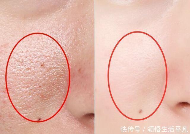 『白色东西』鼻子上挤出来的白色物体是什么皮肤科医生给出这些忠告