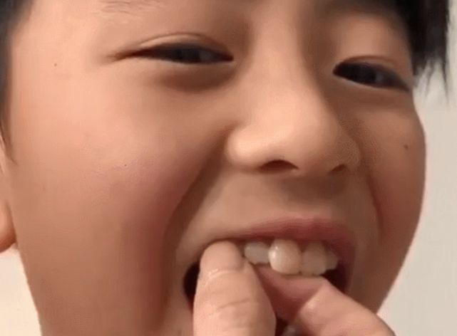 张柏芝给拔牙视频