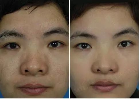 「黄瓜」黄瓜敷脸美白还有用吗?还是来支水光针吧!