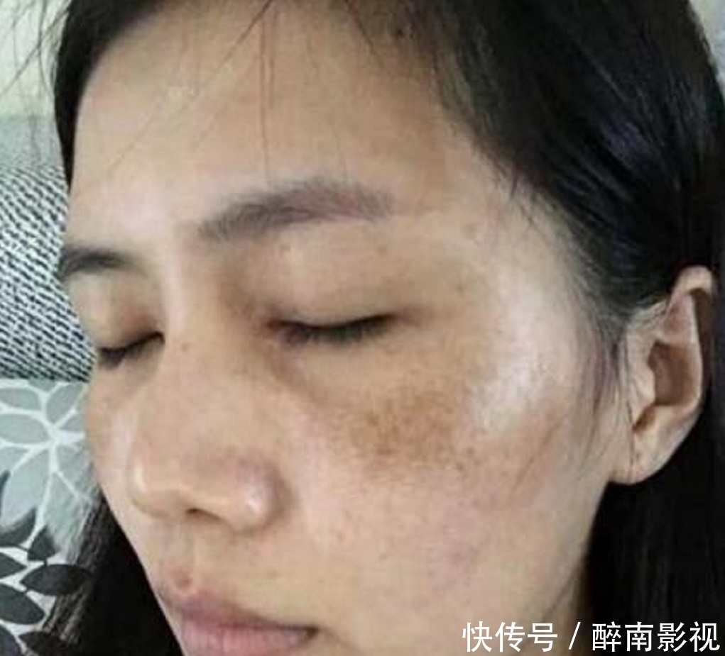 『脸上』女生脸上有色斑,教你一招用生姜加它敷脸,15天轻松告别色斑脸!