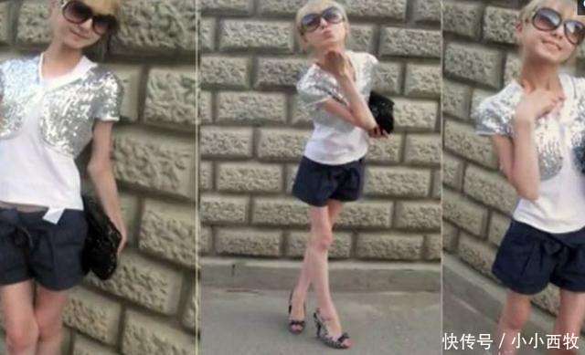 少女因害怕身体走形，每天坚持只喝水不吃食物，如今成“活骷髅”