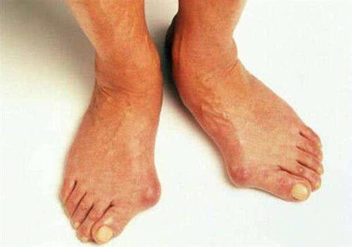 那些长期穿高跟鞋的,脚都变成什么样了?