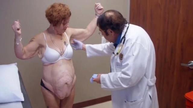 国外辣妈产后体重暴涨，疯狂减肥200斤，撩起衣服后尴尬了