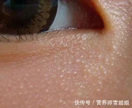 你知道,脸上的“小疙瘩”,挤出来的“白色条状物”,是什么吗?