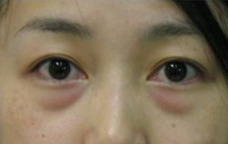 药房便宜的它，只需涂一点，七天美白祛皱，15天眼袋眼纹不见