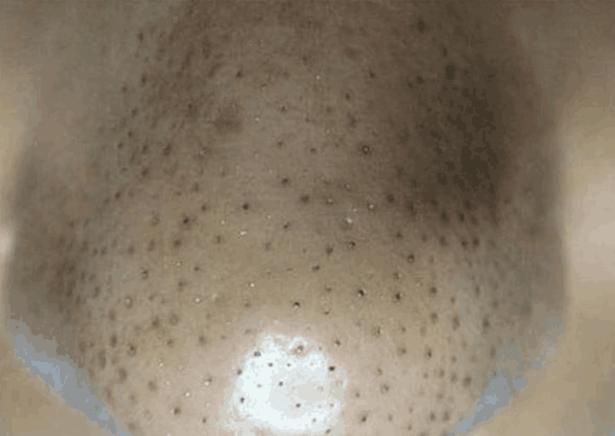 脸上有4个浮现，说明毛孔螨虫“多如牛毛”, 陨灭螨虫只需2招