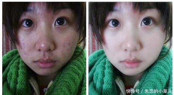 我们脸上竟然布满了肉麻的螨虫!有虫的四种症状,你有吗?