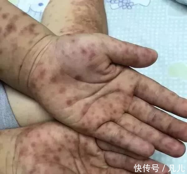 新型手足口病已有宝宝中招,三大症状皮疹、高