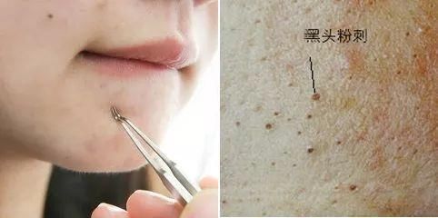 拔出黑头粉刺,地毯式清洁肌肤,还能缩小毛孔!素颜也自带妆容