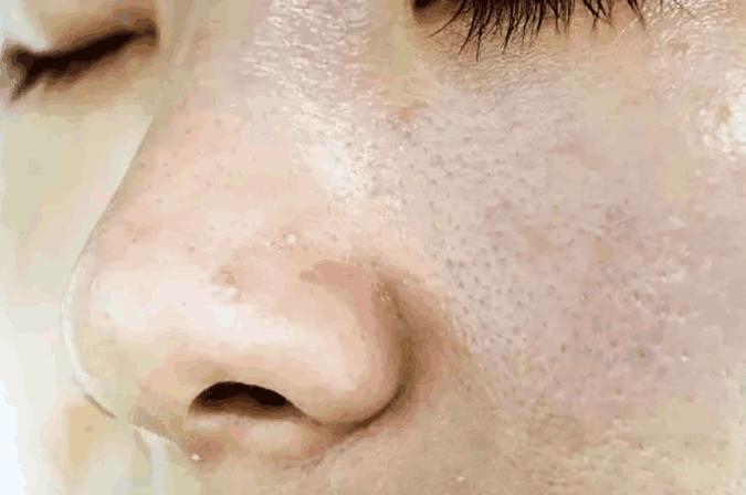 4个异常出现脸部, 十有八九是螨虫, 常用2招除螨, 行之有效