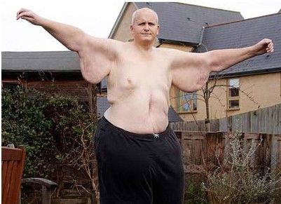 世界最胖男子体重445公斤，用铲车才可以出门，今减肥292公斤!