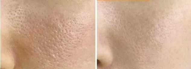 整容遭报应?她的少女脸这么快就烂了?