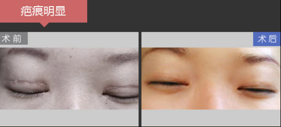 深圳美莱梁志为眼修复案例，她们实现惊艳蜕变