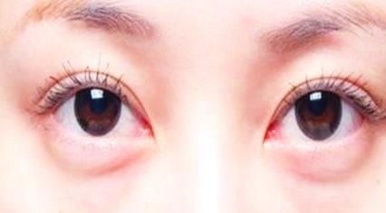  「恢复期」优质解答眼袋外切手术恢复期多久，手术去眼袋后会复发吗？