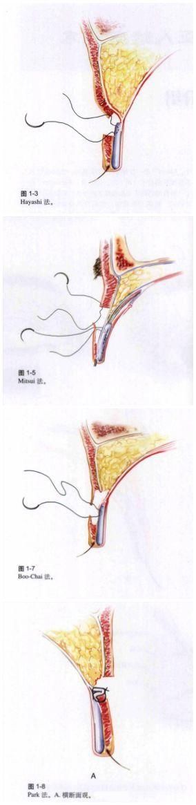 双眼皮“黄金不败宽度”来了!某璐要是早看到也不至于割完眼皮又